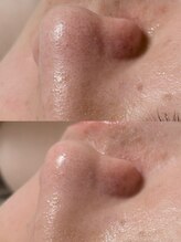 オンド(OND)/いちご鼻・角栓・黒ずみ毛穴