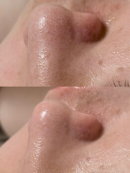 オンド(OND)/いちご鼻・角栓・黒ずみ毛穴