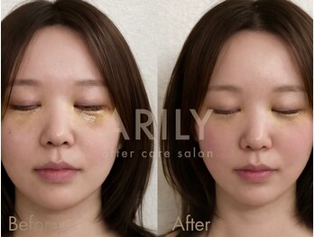 アリリィ(ARILY)の写真/最新インディバ機器を使用!インディバスペシャリスト集団が自信の持てるフェイスラインに導きます。
