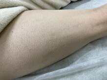 ナノハナ/鹿沼市の全身脱毛のナノハナ