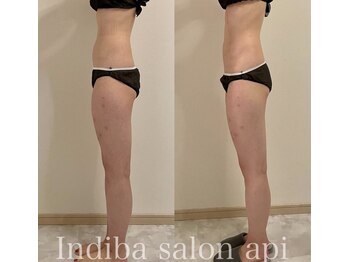 アピ(api)/症例写真【インディバ】