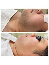 アルゴ 春日那珂川店(ALGO)/メンズ一番人気☆髭脱毛