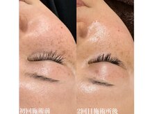 ハクビ(HAKUBI)/シミケア♪