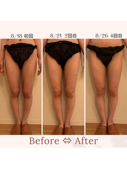 ファミーユ 名古屋店/【術後インディバ】足吸引後ケア