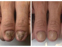 キュアネイル(Qa Nail)/他店で断られた爪もお任せ下さい