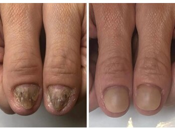 キュアネイル(Qa Nail)/他店で断られた爪もお任せ下さい