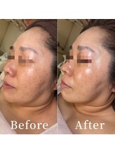 ユカリス(Yu.charis)/水光導入ミコステラBefore/After