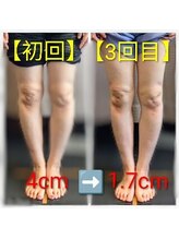 クシロ鍼灸整骨院/【O脚矯正】施術例