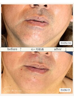 サロンド モーモ(SALON de mo-mo)/4ヶ月でこの結果:髭