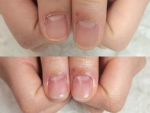 深爪矯正 爪悩み専門店 グラシナ 西宮北口店【4/3 NEW OPEN（予定）】/(深爪/長さだし/フィルイン)