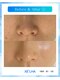 ケセラ(Quesera)の写真/【本気の肌質改善】剥離なしセラピール×アクアピール★次世代ピーリングで繰り返す肌悩みも徹底ケア♪