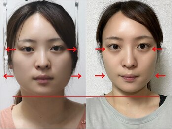 さつま骨格矯正 HRD広尾 西麻布院 /歪み小顔矯正 BeforeAfter
