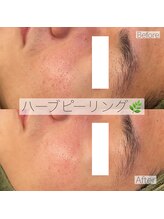エステティックサロンR/毛穴改善◎開きも黒ずみも♪