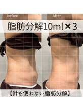 サンポ 神戸元町店(SANPO)/10ml×3回