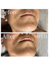 エピノン 山口岩国店(Epinon)/顔脱毛4回ビフォーアフター