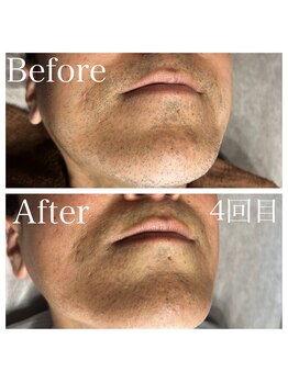 エピノン 山口岩国店(Epinon)/顔脱毛4回ビフォーアフター