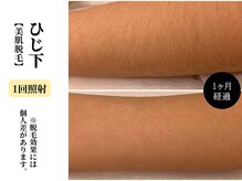 ベルホワイト(Belle White)/【美肌脱毛/ひじ下】