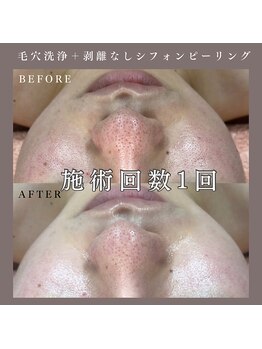 ベルミー(Bellmi)/毛穴洗浄＋シフォンピーリング