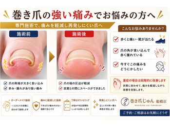 巻き爪じゅん 船橋店/巻き爪の影響とは?