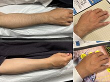 イデアル(ideal)/うで脱毛