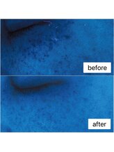 メルスィ 苫小牧店/美容液だけでシミが激変！