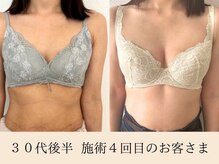 ラーナ(Lana)/バストアップ症例
