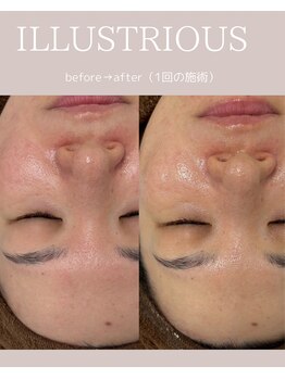 シンスプラス(SINCE+)/美白ピーリング　イラストリアス