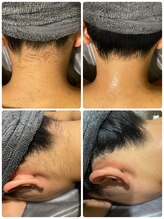 エヌ(enu)/脱毛/うなじ/フェイシャル