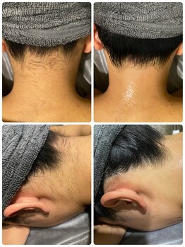 エヌ(enu)/脱毛/うなじ/フェイシャル