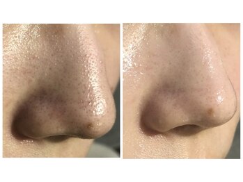 サロン ナビ(salon nabi.)/毛穴洗浄before→after♪