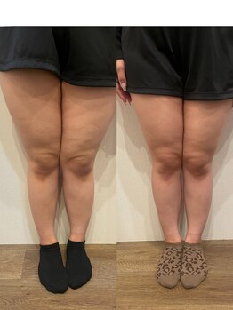 長寿鍼灸院 長寿整骨院/EMS＜太もも集中コース＞