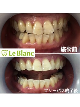 ルブラン 奈良店(Le Blanc)/お特にホワイトニング！