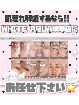 ホワイトアクア 岐阜店(WHITE AQUA)/ララピール/岐阜/毛穴