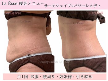 ラエッセ(La Esse)/妊娠線もキュッとつるんと♪