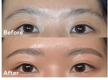 アルカナ(ARCANA)/HBL（ハリウッドブロウリフト）