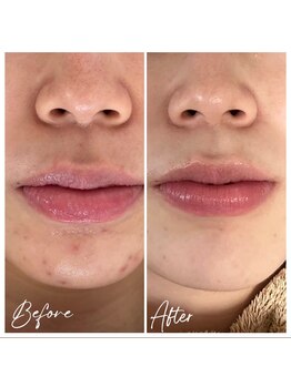 ココ 2号店(CoCo)/肌質改善/ニキビケア