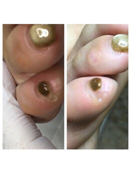 プラスキュア 用賀店(+CURE)/肥厚爪 変形爪 副爪 60分6600~