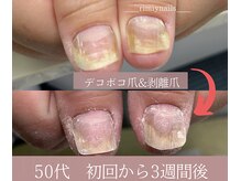 繰り返さない深爪!ネイルを楽しみながら内側からしっかりと育成