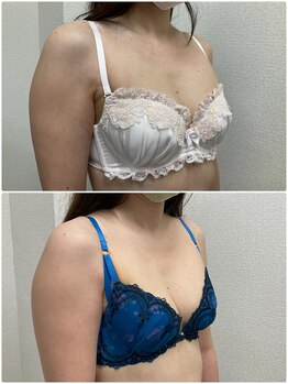 バーディー(BIRDIE)/施術５回/30代/B→Cカップ