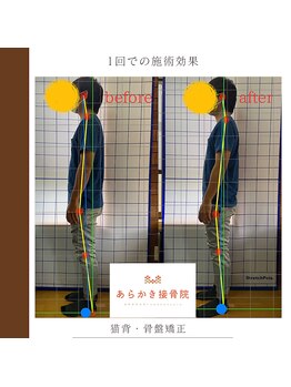 あらかき接骨院/姿勢の変化
