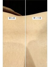 シノ 銀座(shino)/背中ニキビケア！綺麗な背中へ