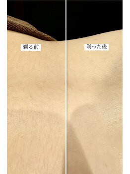 シノ 銀座(shino)/背中ニキビケア！綺麗な背中へ