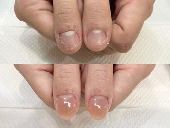 【SNAPPY ネイルズ＆ブロウズ BLiX茅ヶ崎店】ジェル・深爪矯正・巻き爪・眉専門店/深爪矯正 自爪育成 ネイルケア