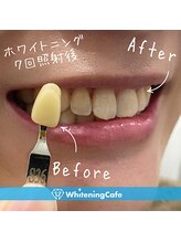 ホワイトニングカフェ 池袋東口店/ホワイトニングビフォーアフター
