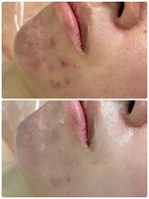 ビビ(Be_bi)/ニキビケア☆