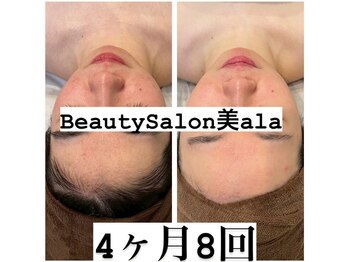 ビアラ(美ala)/ニキビケア/4ヶ月8回