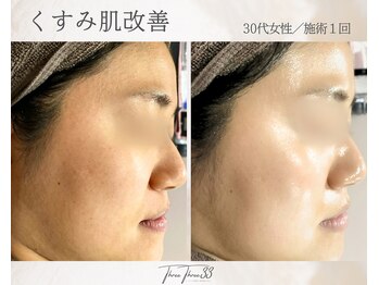 スリースリー 恵比寿(THREE THREE)/くすみ肌・透明感UP ケア