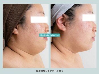 ソウルスキンの写真/【韓国で話題!】脂肪分解レモンボトル導入!気になる二重あご・フェイスラインのたるみに徹底アプローチ★