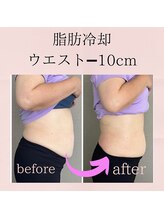 エリーズ(Elise)/脂肪冷却＋整体(2回目)