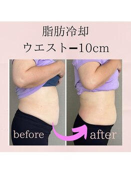 エリーズ(Elise)/脂肪冷却＋整体(2回目)